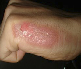 Qué hacer después de sufrir una quemadura